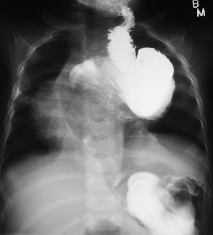 Interposition of the Colon